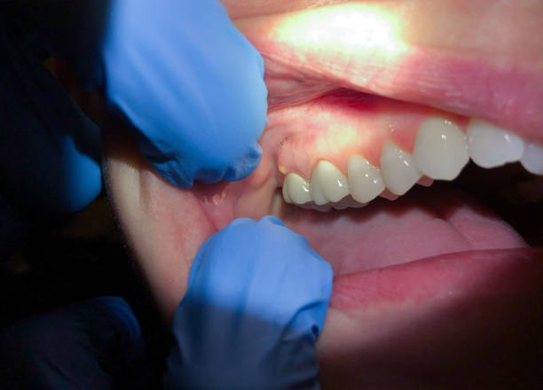 Best Emergency Wisdom Teeth Removal in Lindenhurst, NY